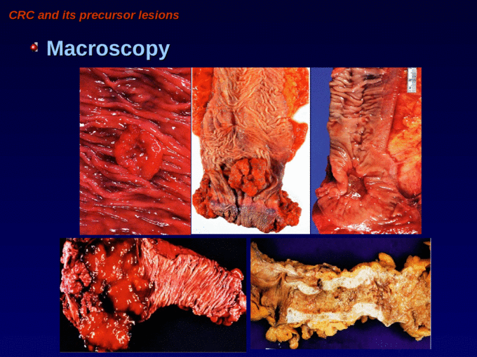 text of 大肠癌及其癌前病变 colorectal carcinoma and its