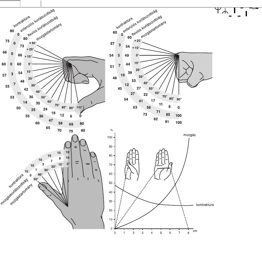 a 3. fokú kéz disztális interfalangeális ízületei artrózisa